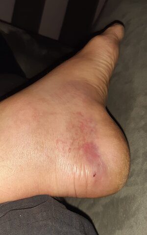 How to Avoid Snakes While Hiking (My Trail-Tested Guide) snake bite in feet