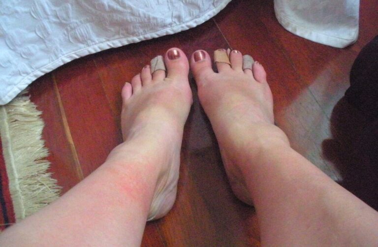 Swollen Feet After Hiking? (Causes, Treatment & Prevention) swollen feet after hiking