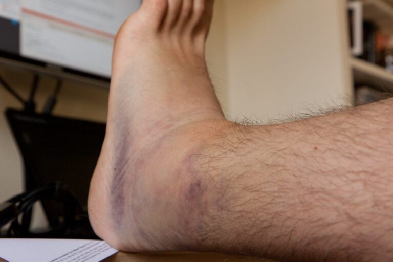 a person having his foot and ankle injured because of wearing hiking boots